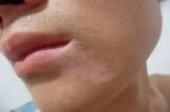 男性白癜风患者要注意正规治疗.jpg