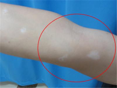 白癜风病情遗传的情况是怎样的.jpg