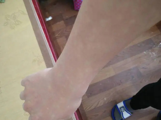 患者早期的白癜风看的好么.jpg
