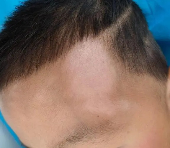 白斑怎么治才能根除.jpg