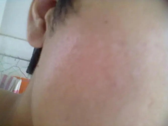 恢复期的白斑是啥样.jpg