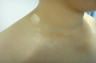 乳白色的白癜风是白癜风.jpg