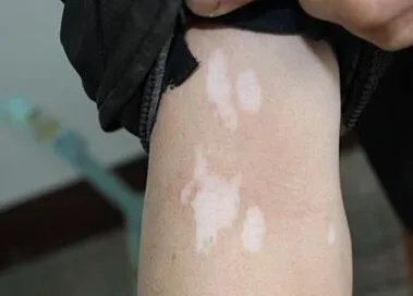 白癜风患者.JPG