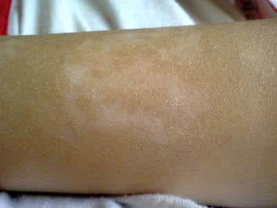 如何治疗大腿上的白癜风.jpg