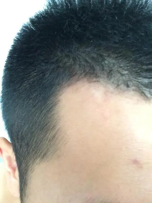 白癜风吃什么食物可以自愈.jpg
