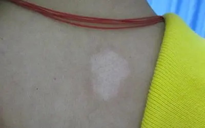 小孩白斑.jpg