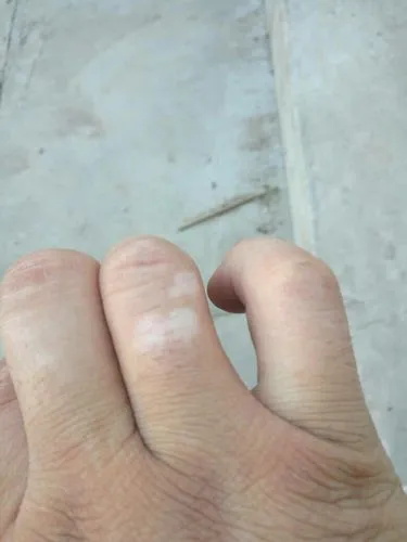 黑色素缺失导致的白斑.jpg